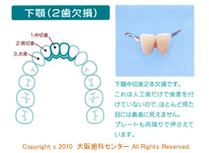 MTコネクター