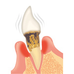 歯周病の進行